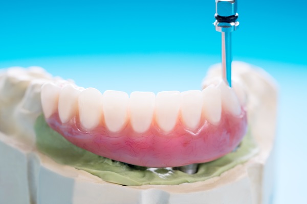 Common Questions And Answers About Implant Supported Dentures